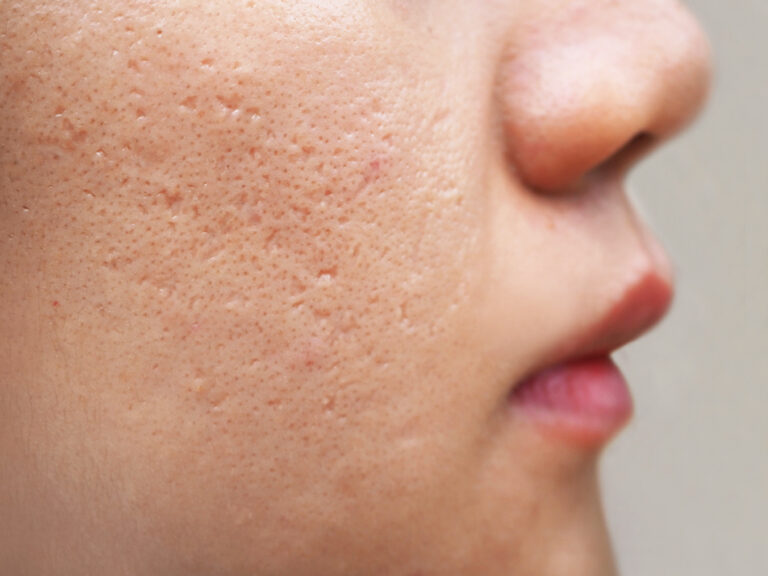 Cosmetic Condition Acne Scars