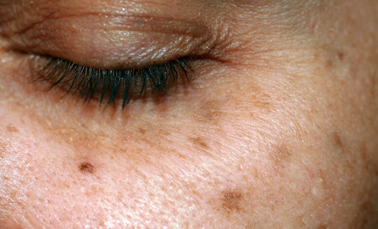 Cosmetic Condition Brown Spots