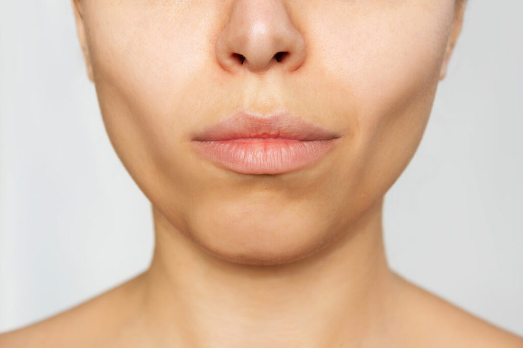 Cosmetic Condition Facial Volume Loss