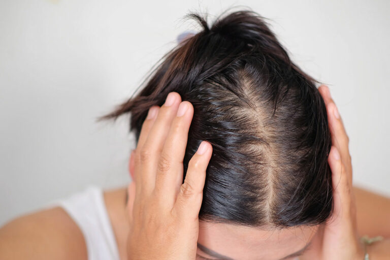Cosmetic Condition Hair Loss