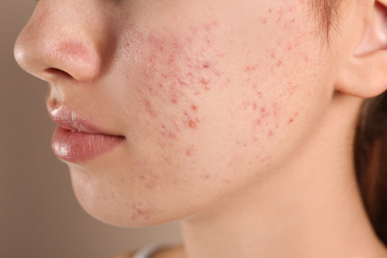 Skin Condition Acne