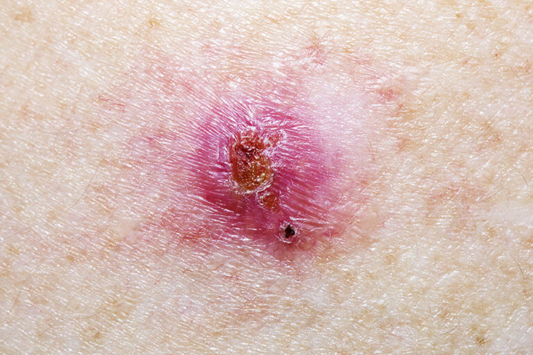 Skin Condition Basal Cell Carcinoma
