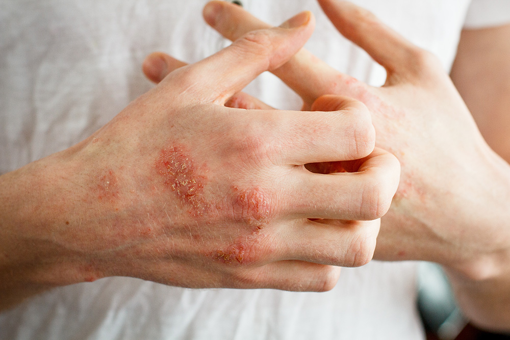 Skin Condition Eczema
