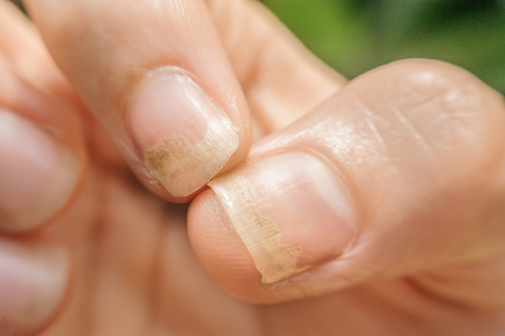 Skin Condition Nail Fungus