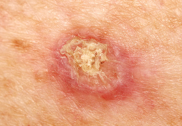 Skin Condition Squamous Cell Carcinoma